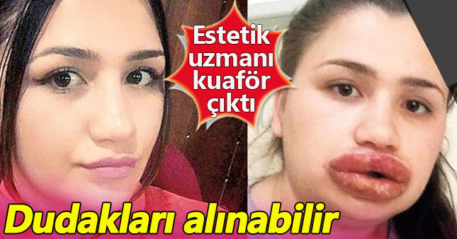 Dudak silikonu hayatını kararttı!
