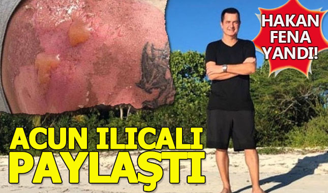 Acun'un yanık paylaşımı