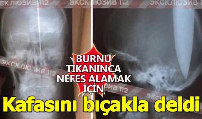 Burnu tıkanınca kafasını deldi!