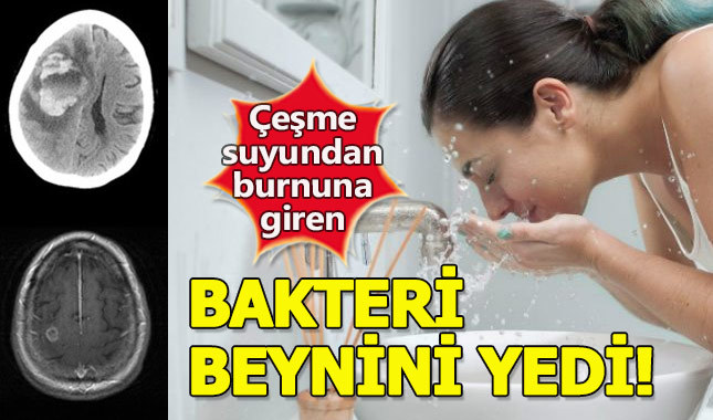 Çeşmeden içtiği sudan beynine giren bakteriler ölümüne neden oldu