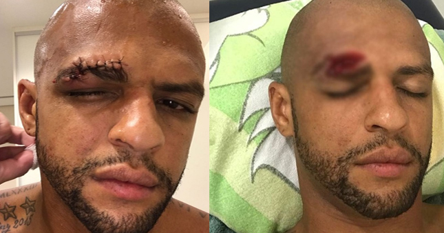 Felipe Melo'nun son hali şok etti