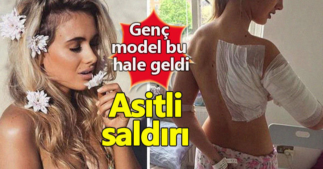Gece kulübünde genç modele asit dehşeti!