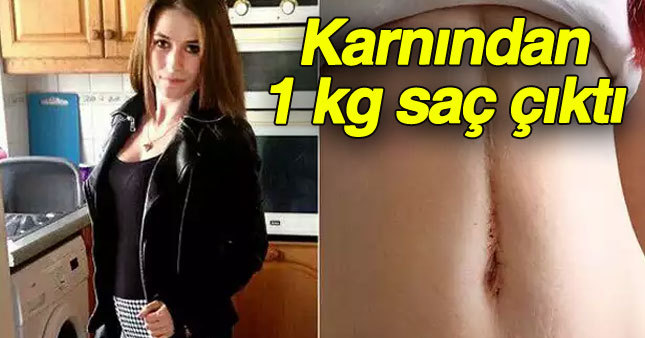 Genç kadının karnından 1 kg saç çıktı
