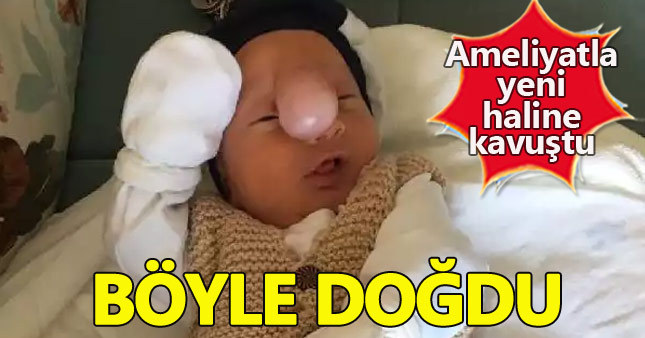 İki haftalık bebeğin yüzündeki kitle alındı