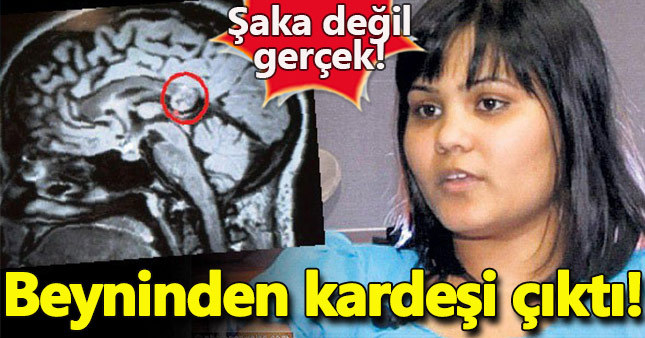 İnanılmaz olay! Beyninden ikiz kardeşi çıktı!