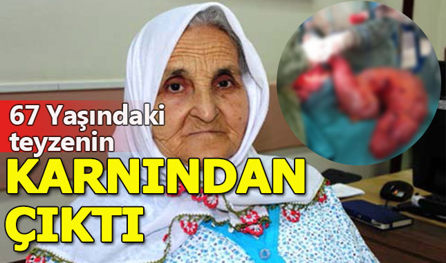 Karın ağrısı şikayetiyle hastaneye gitti, doktorlar şok oldu
