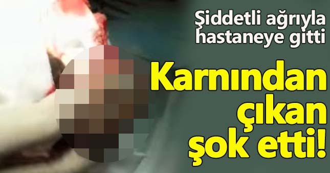 Karın ağrıyla gitti, bağırsağından saç çıktı