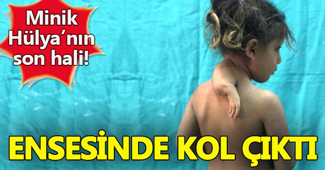 Minik Hülya Ensesinde 3. kol ile doğmuştu!