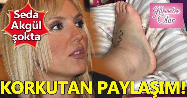 Seda Akgül'ün ayağına ne oldu? kırık mı? çıkık mı? çatlak mı?