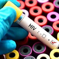 AIDS tedavisinde devrim gibi buluş!