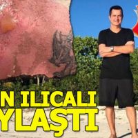 Acun'un yanık paylaşımı