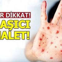 Aileler dikkat:Kızamık hastalığı sayısında büyük artış!