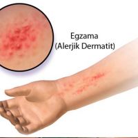 Egzama nedir ve belirtileri nelerdir bulaşıcı mı?
