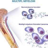 Miyelom hastalığı nedir? Belirtileri nelerdir? Tedavisi nasıl olur