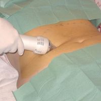 Rasping nedir, nasıl uygulanır? Rasping zayıflamak nedir?