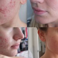 Roaccutane nedir, yan etkileri nelerdir?