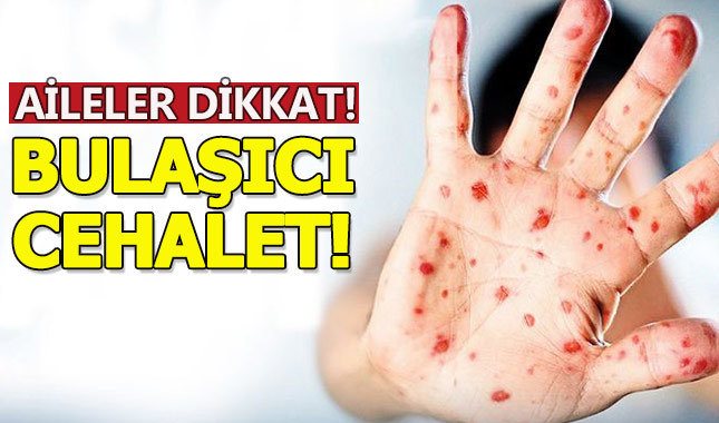 Aileler dikkat:Kızamık hastalığı sayısında büyük artış!