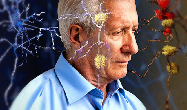 Alzheimer tehlikesine karşı minyatür beyin ürettiler