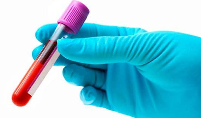Anti HCV nedir | Elisa Testi Neden Yapılır | Negatif / pozitif çıkması ne anlama gelir | Normal değerler ne olmalı?
