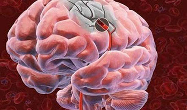 Beyin damarı tıkanıklığının nedenleri, belirtileri nedir, tedavisi nasıl olur?