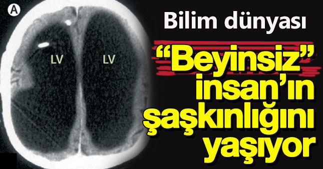 "Beyinsiz" insan bilim dünyasını şok etti