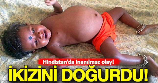 Hindistan'da bebeğin karnından ikizi çıktı