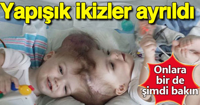 Kafası yapışık ikizler ayrıldı