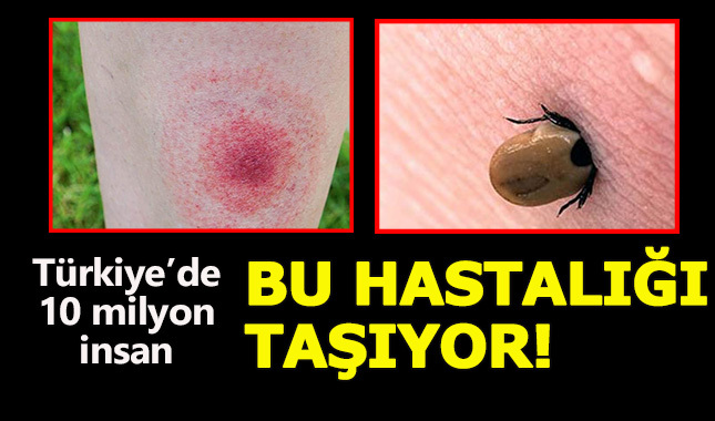 Lyme hastalığı nedir, belirtileri ve tedavi yöntemleri nelerdir?