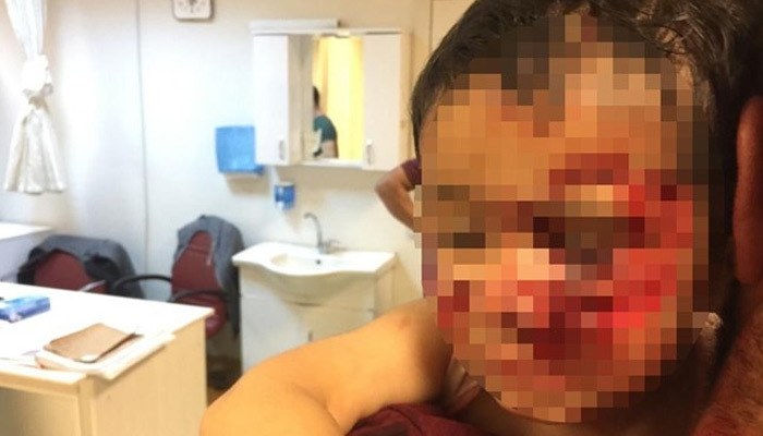 Şanlıurfa'da 6 küçük çocuğa köpek saldırdı