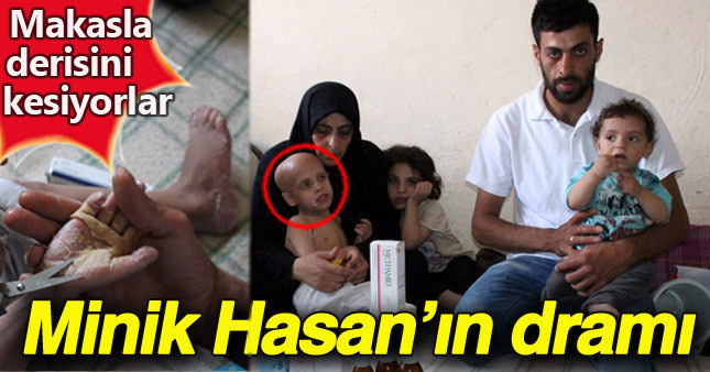 Suriyeli minik Hasan’ın yürek burkan hikayesi