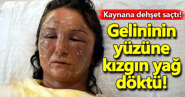 Uyuyan gelininin yüzüne kızgın yağ döktü!