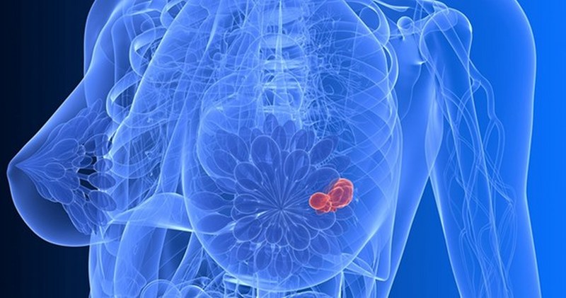 Erkeklerinde risk altında bulunduğu Meme kanseri riskini artıran 8 sebep! A24