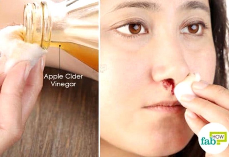 Burun kanamasını 5 dakikada durduran etkili yöntemler A24