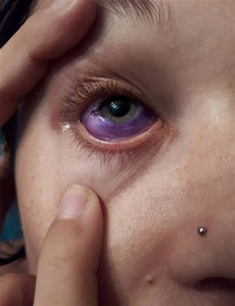 Göz renklerini değiştirmek için kör kalmayı göze alan güzeller! A24