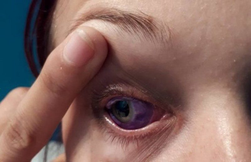 Göz renklerini değiştirmek için kör kalmayı göze alan güzeller! A24